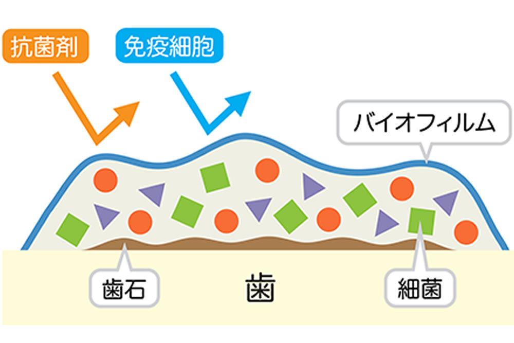 本八幡（市川市）の歯医者、並木デンタルクリニックの予防歯科