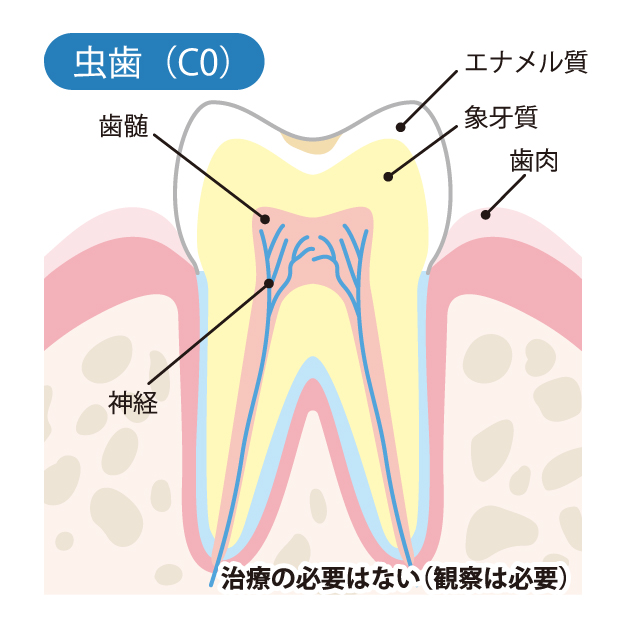 本八幡（市川市）の歯医者、並木デンタルクリニックで虫歯治療