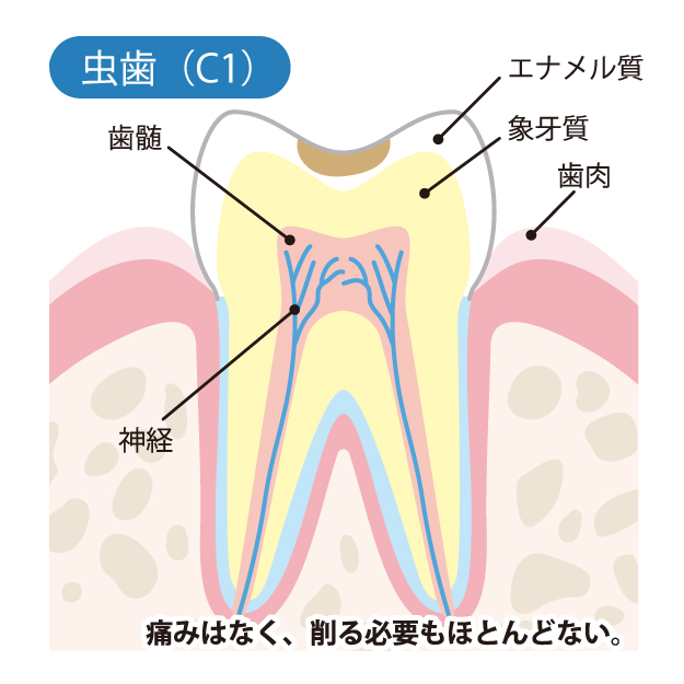 本八幡（市川市）の歯医者、並木デンタルクリニックで虫歯治療