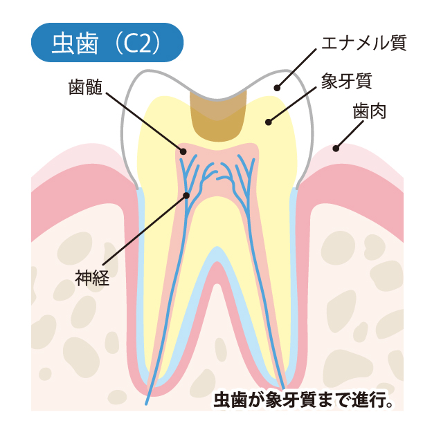 本八幡（市川市）の歯医者、並木デンタルクリニックで虫歯治療