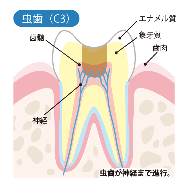 本八幡（市川市）の歯医者、並木デンタルクリニックで虫歯治療