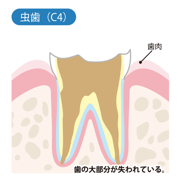 本八幡（市川市）の歯医者、並木デンタルクリニックで虫歯治療