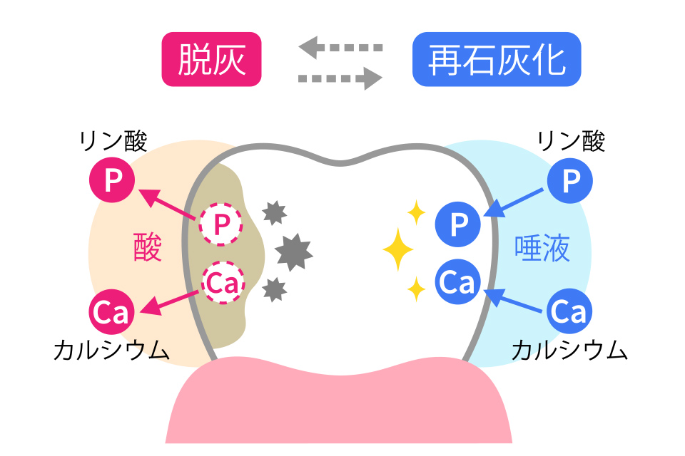 本八幡（市川市）の歯医者、並木デンタルクリニックで虫歯治療