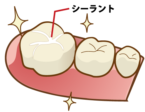 本八幡（市川市）の歯医者、並木デンタルクリニックのシーラント